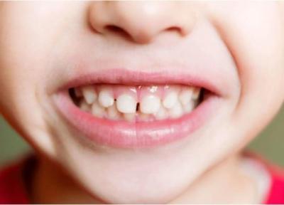 لیست دارو هایی که باعث نقص مینای دندان بچه ها می شوند